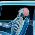 Can Whiplash be Treated Years Later?